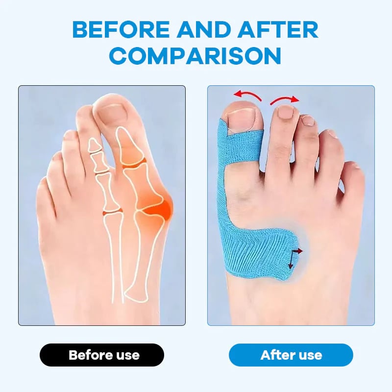 🔥💞LAST DAY 50% OFF ✨Bunion Relief Toe Correction Wrap