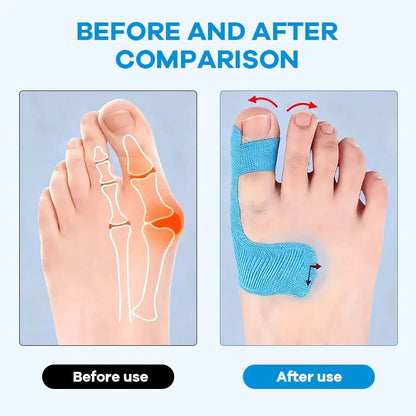 🔥💞LAST DAY 50% OFF ✨Bunion Relief Toe Correction Wrap
