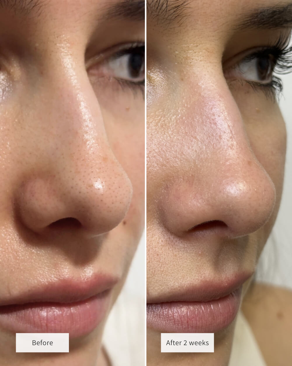 🧄💞LAST DAY 50% OFF ✨Deep-Clean Nose Strips – Removes Blackheads & Tightens Pores