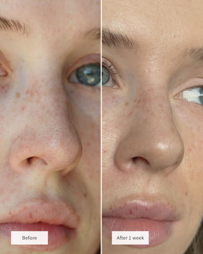 🧄💞LAST DAY 50% OFF ✨Deep-Clean Nose Strips – Removes Blackheads & Tightens Pores