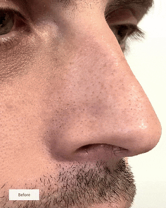 🧄💞LAST DAY 50% OFF ✨Deep-Clean Nose Strips – Removes Blackheads & Tightens Pores